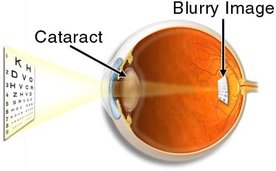 Eye Cataract Vision